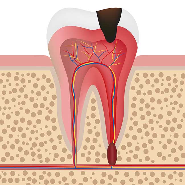 Root Canal 3D Image