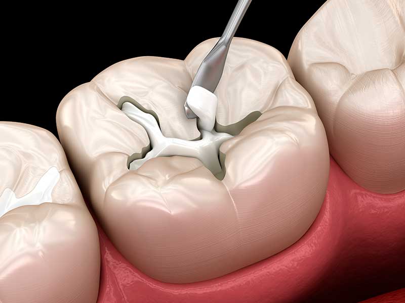 Composite Dental Filling in Bendigo VIC Area