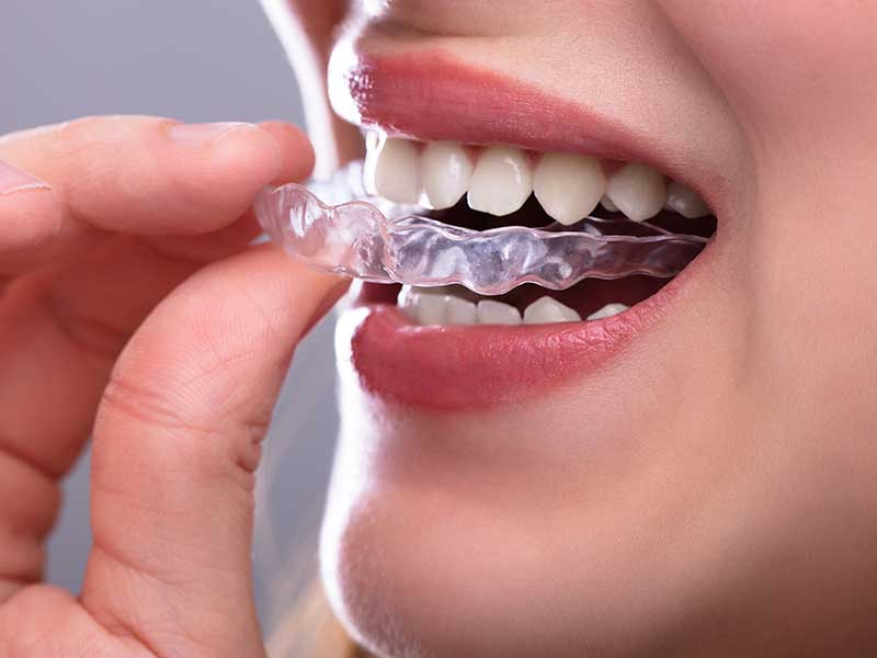 Invisible Teeth Straightening in Bendigo VIC Area