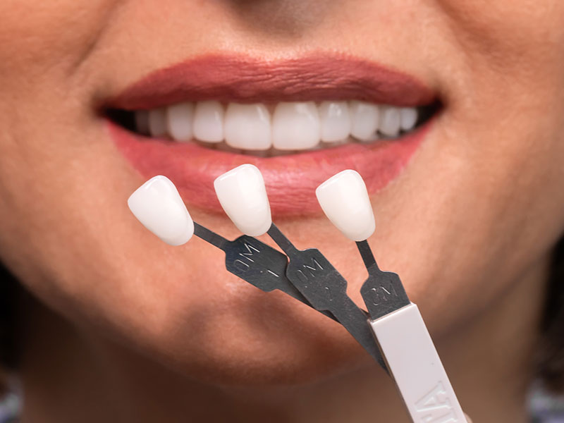 Veneers teeth procedure in Bendigo VIC area
