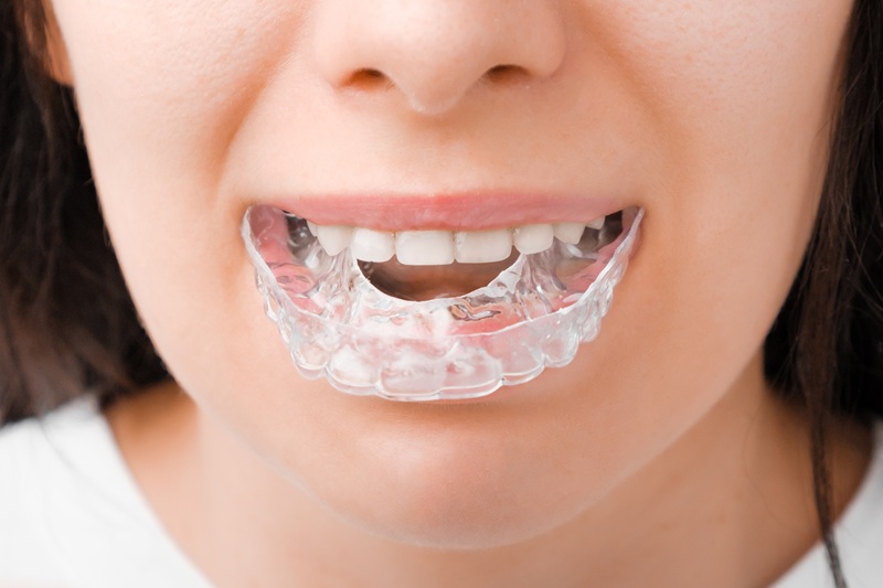 Smiling woman with perfect and healthy teeth using removable braces or aligner for straightening teeth.